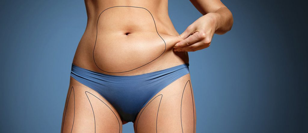 Liposuction information 